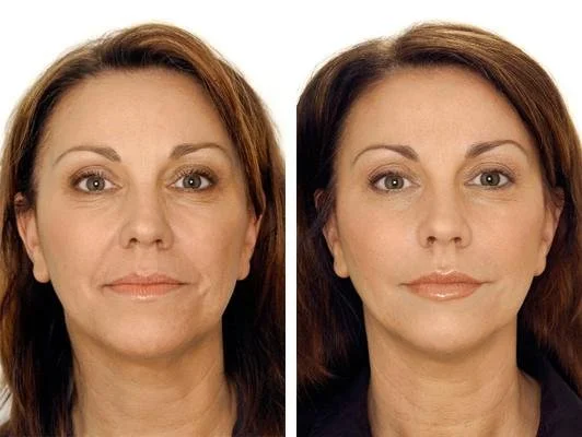 Dysport Cosmetic Injections | Smooth Look, Natural Feel — North